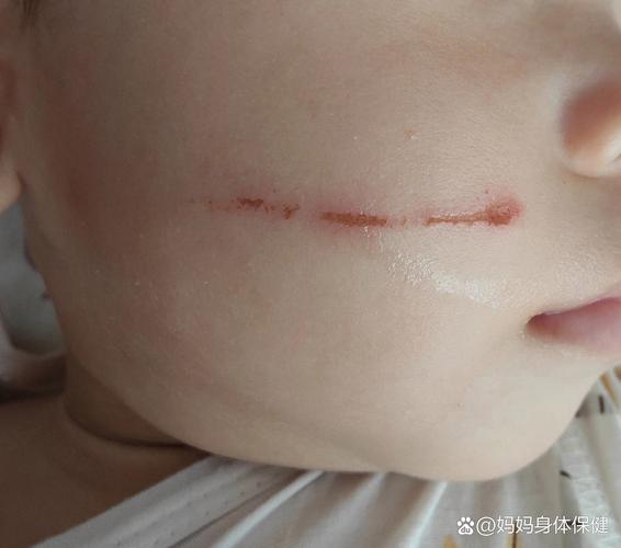 抠破皮肤会留疤吗?