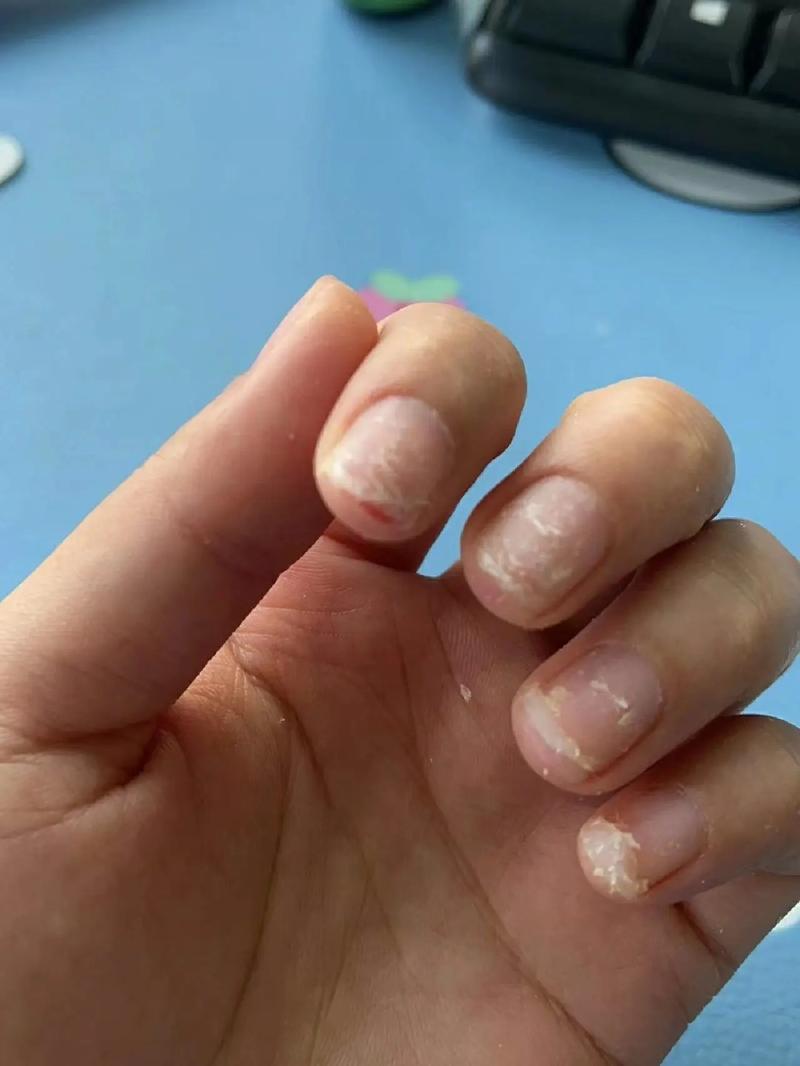 抠破皮肤会留疤吗?