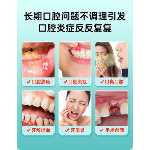 口腔溃疡散涂多久能好?