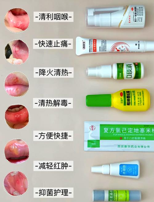 口腔溃疡散涂多久能好?