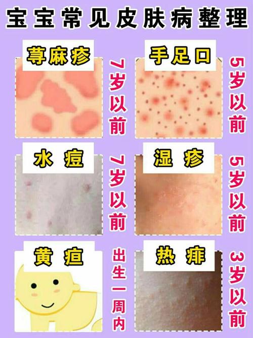 婴儿常见皮肤病有哪些?