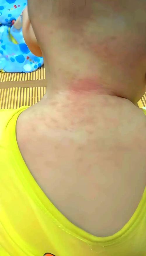 婴儿常见皮肤病有哪些?