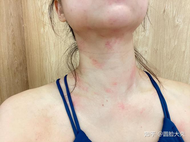 上火会引发皮肤过敏吗?