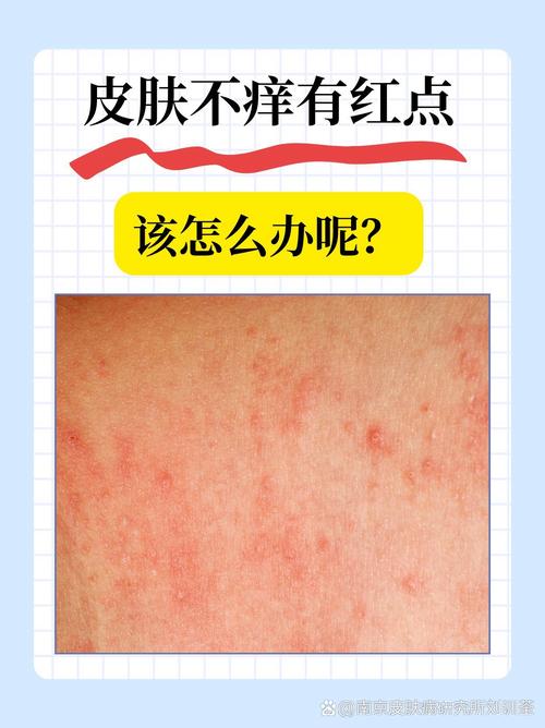 上火会引发皮肤过敏吗?