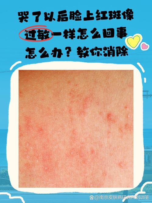 上火会引发皮肤过敏吗?