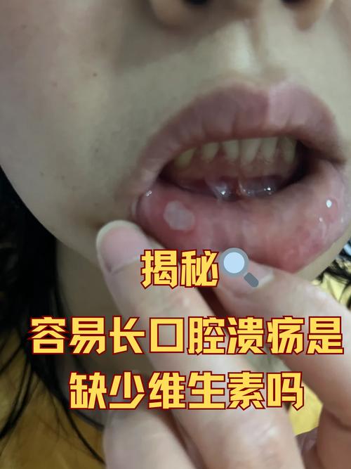 口腔溃疡能吃哈密瓜吗?
