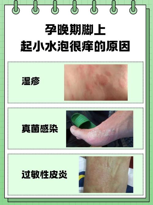 怀孕皮肤总痒?孕期皮肤瘙痒原因何在?