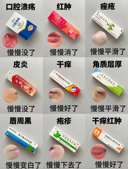 口腔溃疡擦什么好得快?