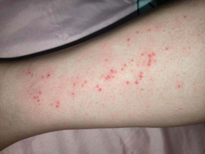 夜间腿部皮肤瘙痒为何频发?