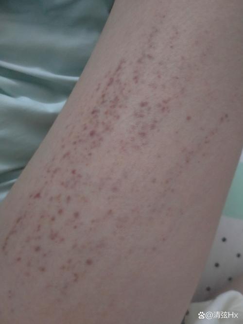 夜间腿部皮肤瘙痒为何频发?