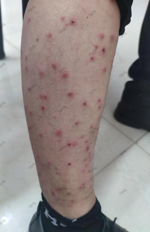 夜间腿部皮肤瘙痒为何频发?