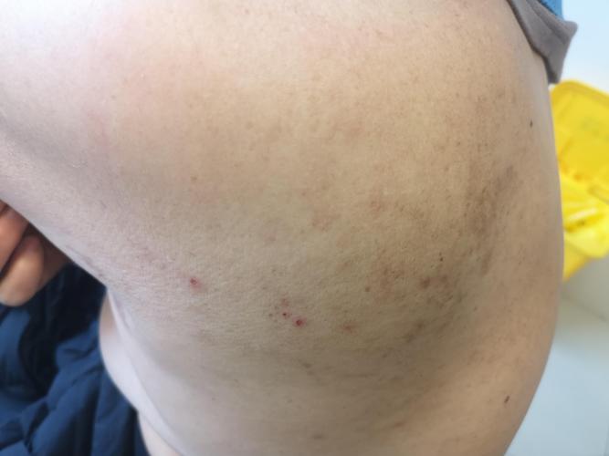 尿毒症为何引发皮肤瘙痒?