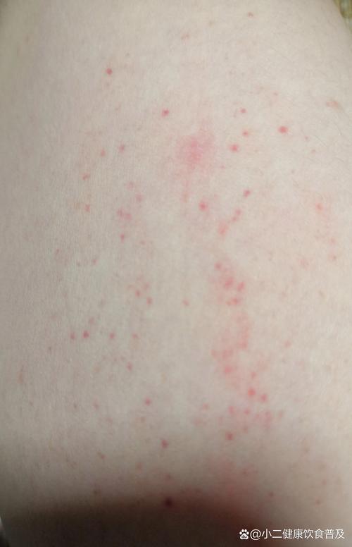 皮肤红点内有血是何原因?