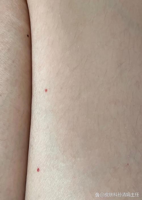 皮肤红点内有血是何原因?