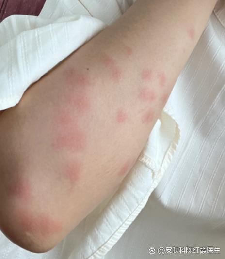 冬天皮肤起小疙瘩很痒怎么办?