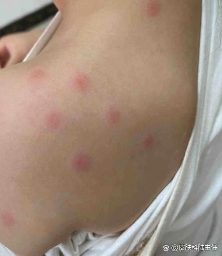 冬天皮肤起小疙瘩很痒怎么办?