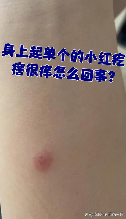 冬天皮肤起小疙瘩很痒怎么办?