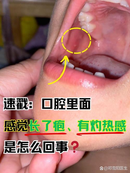 口腔起泡是啥原因?