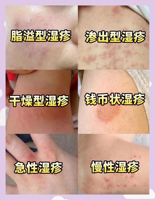 皮肤容易湿疹是缺什么