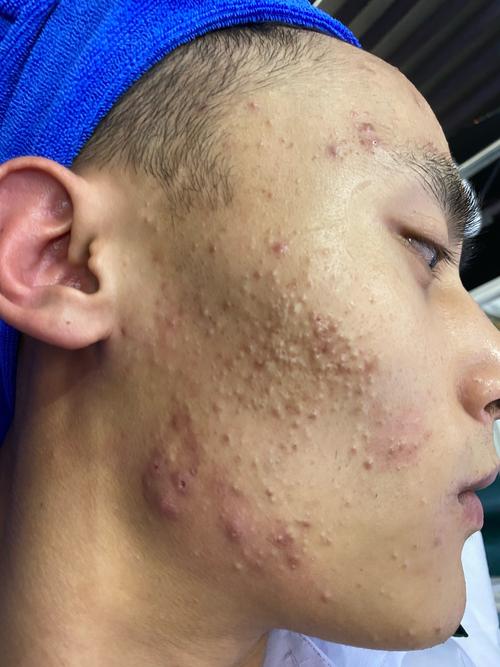 上海皮肤病医院痤疮如何有效治疗?