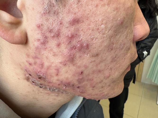 上海皮肤病医院痤疮如何有效治疗?