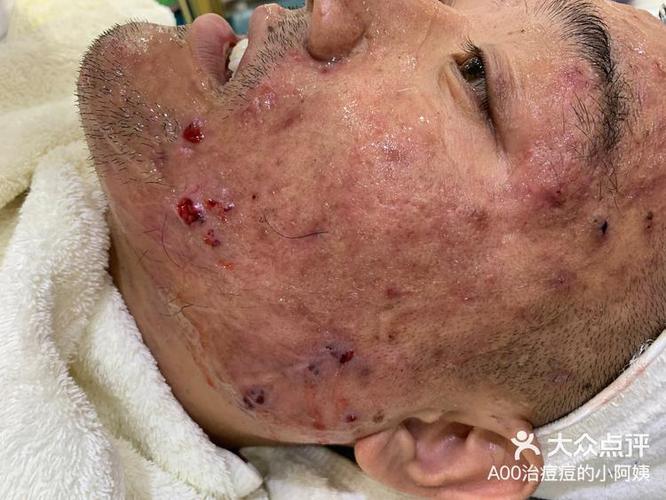 上海皮肤病医院痤疮如何有效治疗?