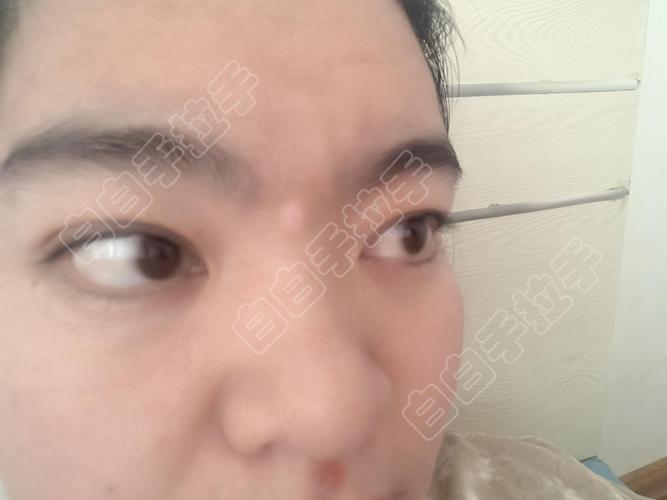 眉毛上方皮肤发白是何原因?