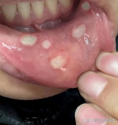 口腔溃疡能不能吃槟榔