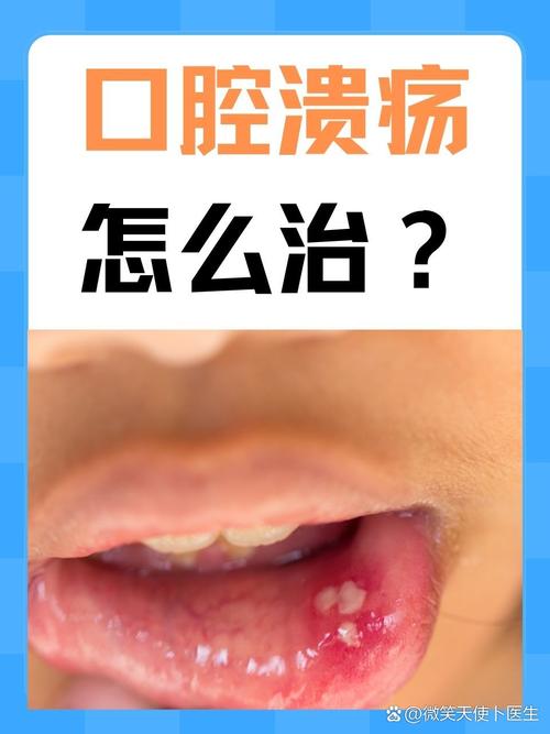 口腔溃疡能不能吃槟榔