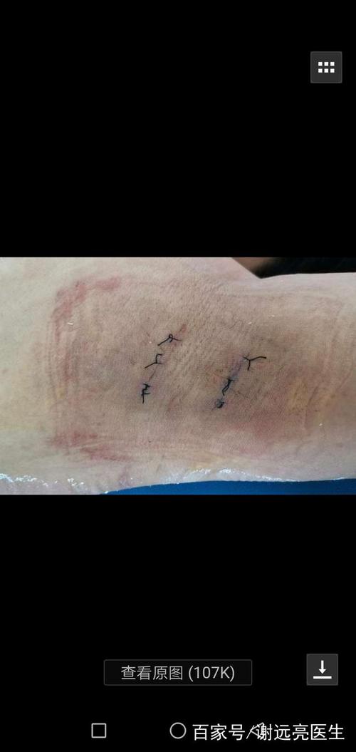 皮肤上有个洞挤出黑色