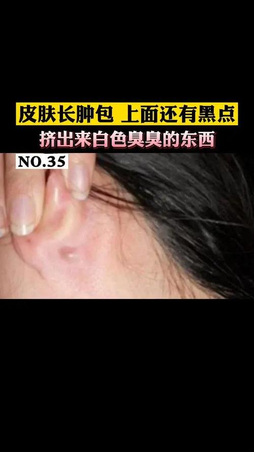 皮肤上有个洞挤出黑色