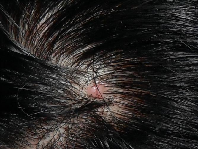 皮肤上有个洞挤出黑色