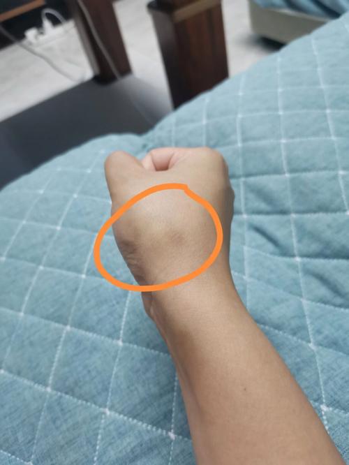 皮肤下面有硬疙瘩青色