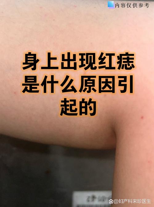 皮肤长红痣是何原因?