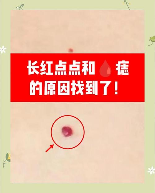 皮肤长红痣是何原因?