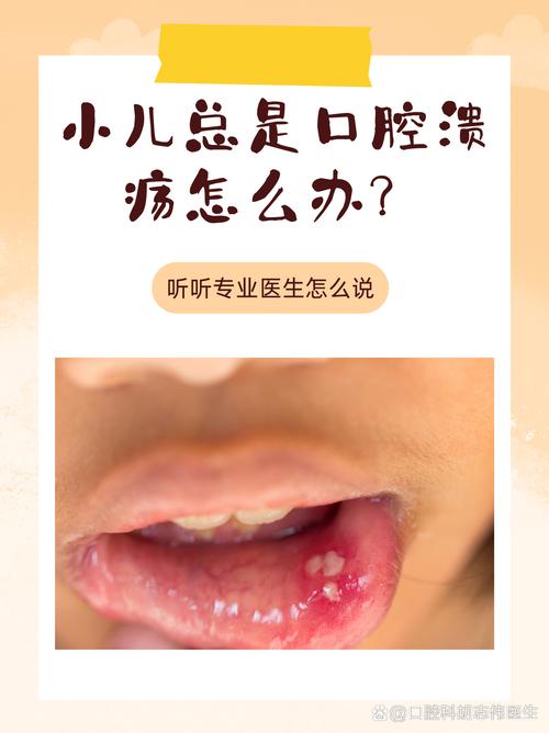 新生儿口腔溃疡怎么治?