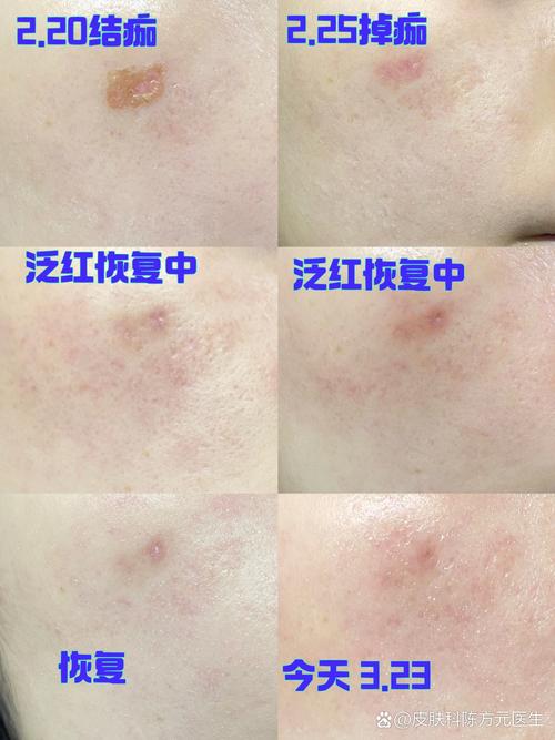 激光祛斑痂掉了皮肤红