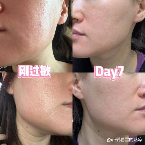 皮肤过敏不治能自己好？