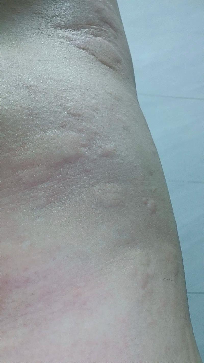 淋巴瘤为何引发皮肤瘙痒？