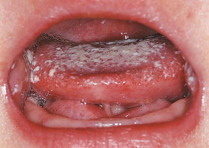 口腔白色念珠菌有哪些典型表现？