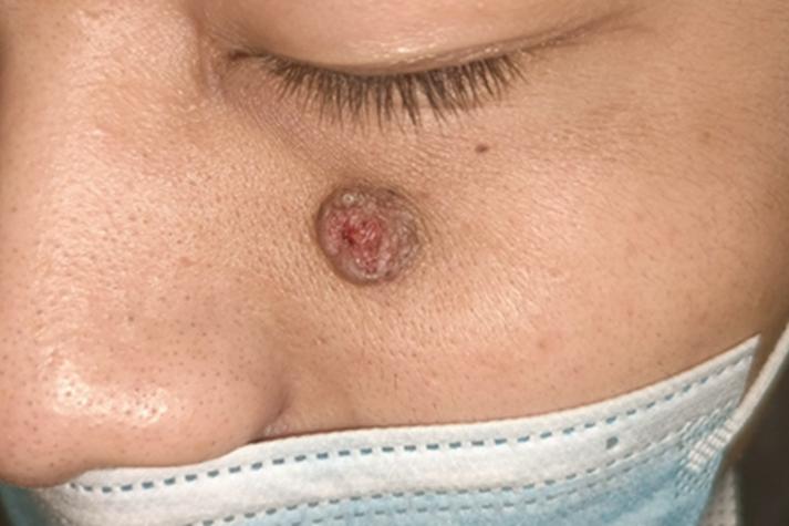 皮肤癌早期症状有哪些？