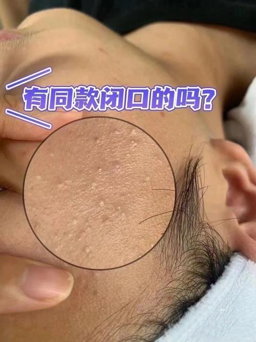 皮肤闭口是怎么形成的?