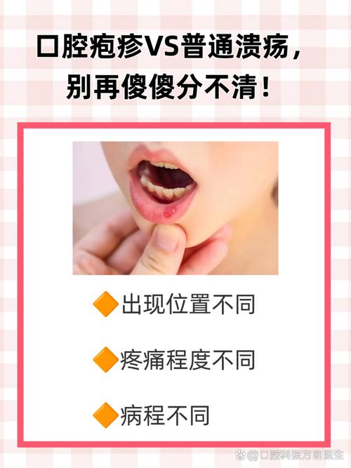 疱疹和口腔溃疡是一回事吗?