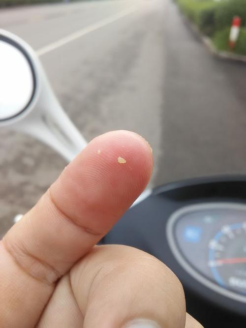 皮肤挤出白色米粒硬物是啥?咋回事?