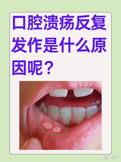 口腔腐烂是什么病症状