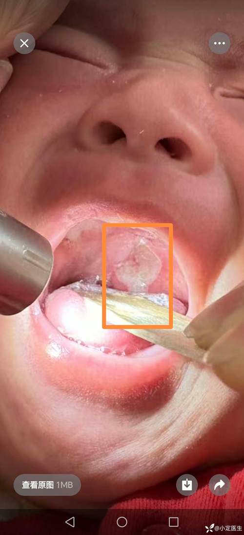 口腔腐烂是什么病症状