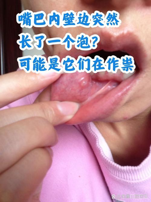 口腔起水泡是上火还是疾病?