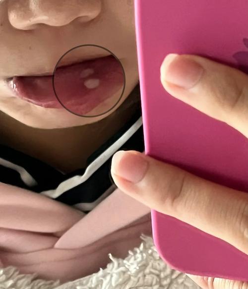 口腔溃疡抹上白糖好疼