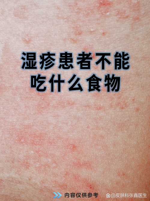 皮炎湿疹患者需忌口哪些食物?