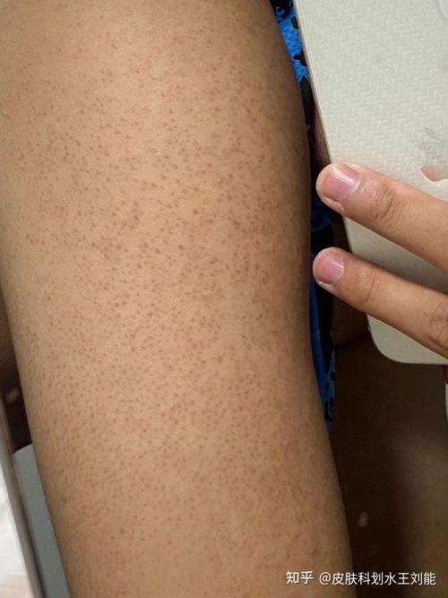 身上一小块粗糙皮肤是啥问题?